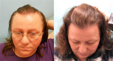 finasteride for hair loss women